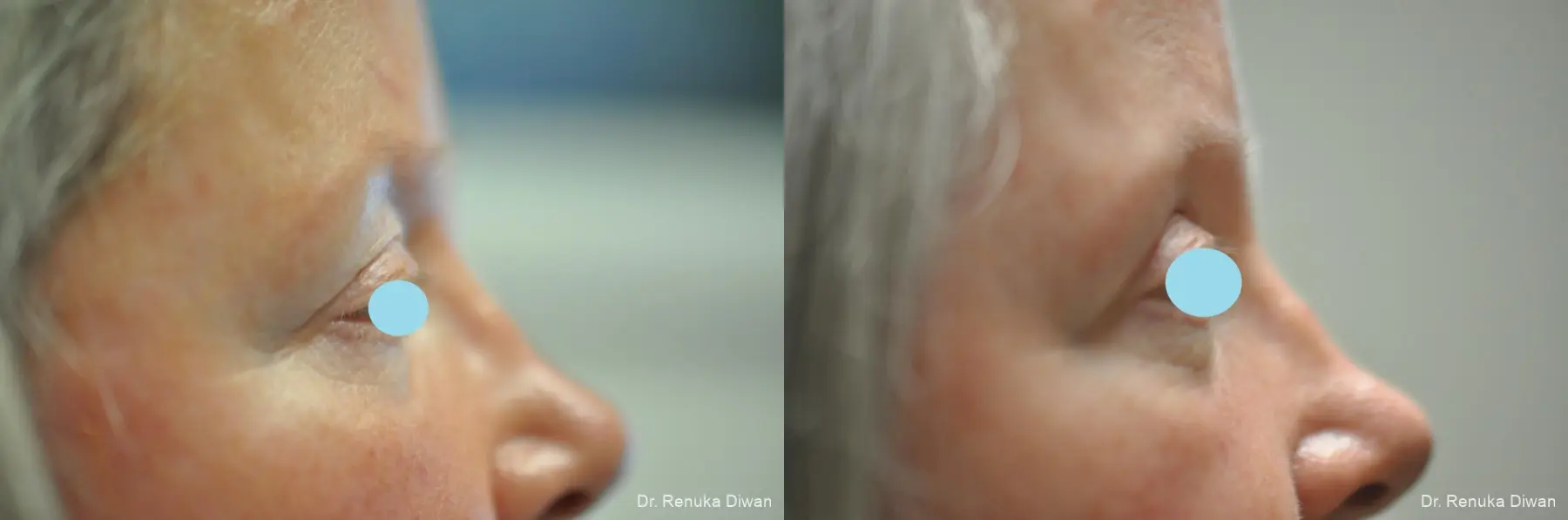 Blepharoplasty: Patient 19 - Before and After 3