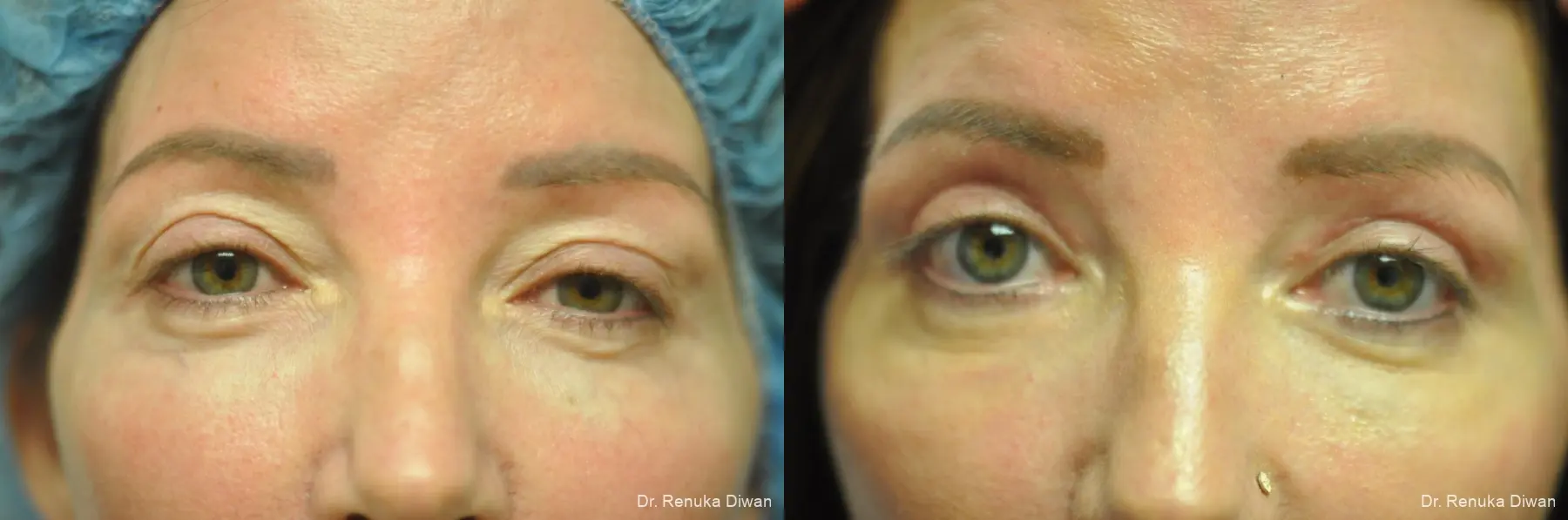 Blepharoplasty: Patient 23 - Before and After 3