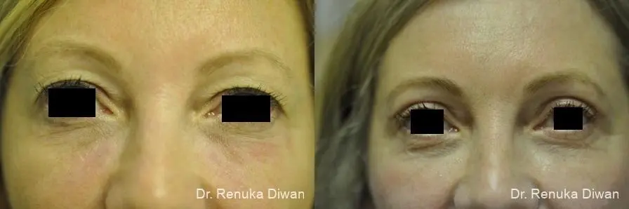 Blepharoplasty: Patient 6 - Before and After 1