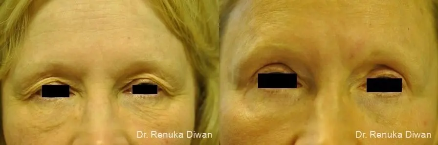 Blepharoplasty: Patient 17 - Before and After 1