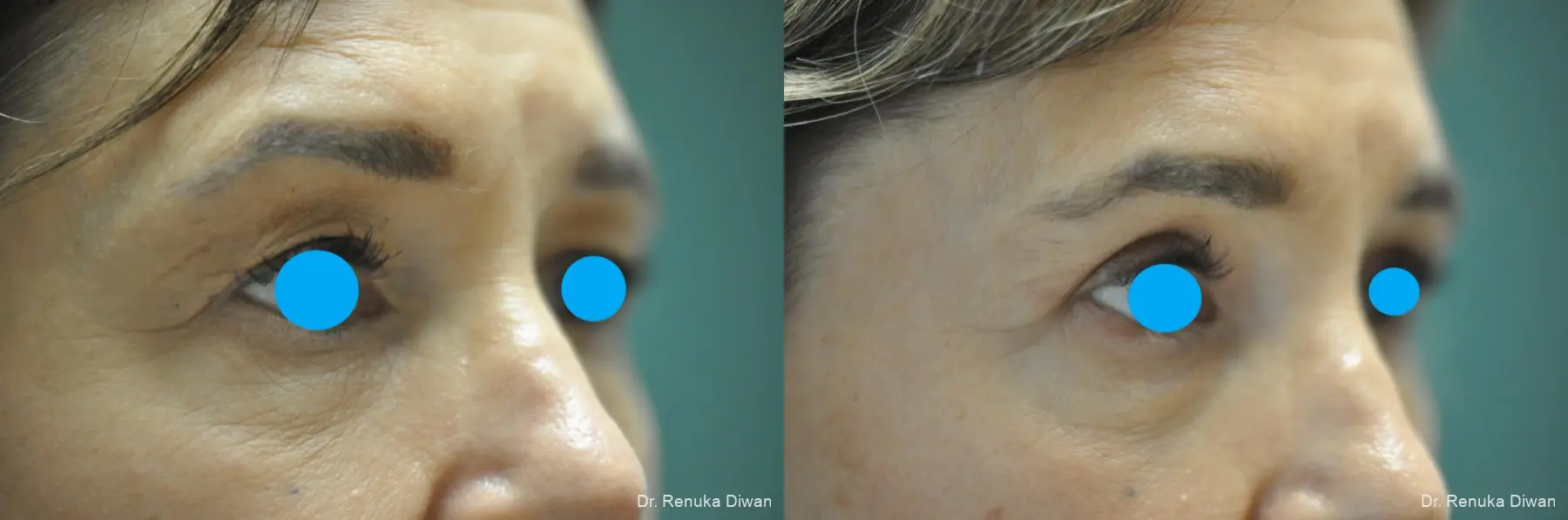 Blepharoplasty: Patient 21 - Before and After 2