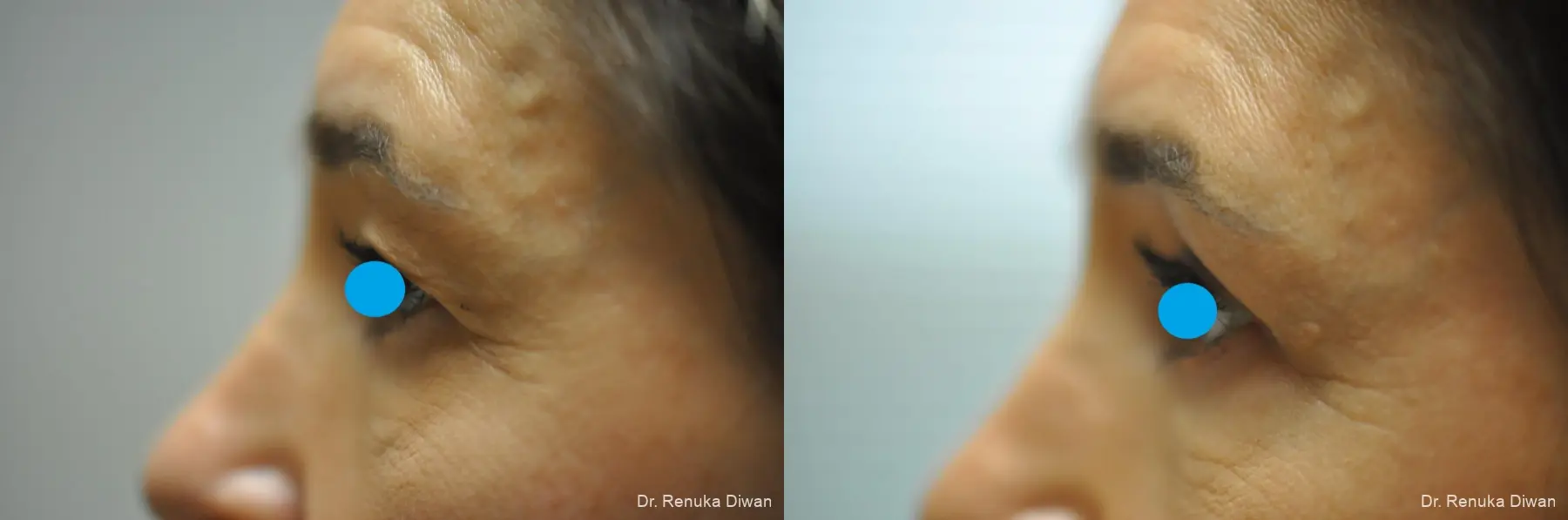 Blepharoplasty: Patient 22 - Before and After 1