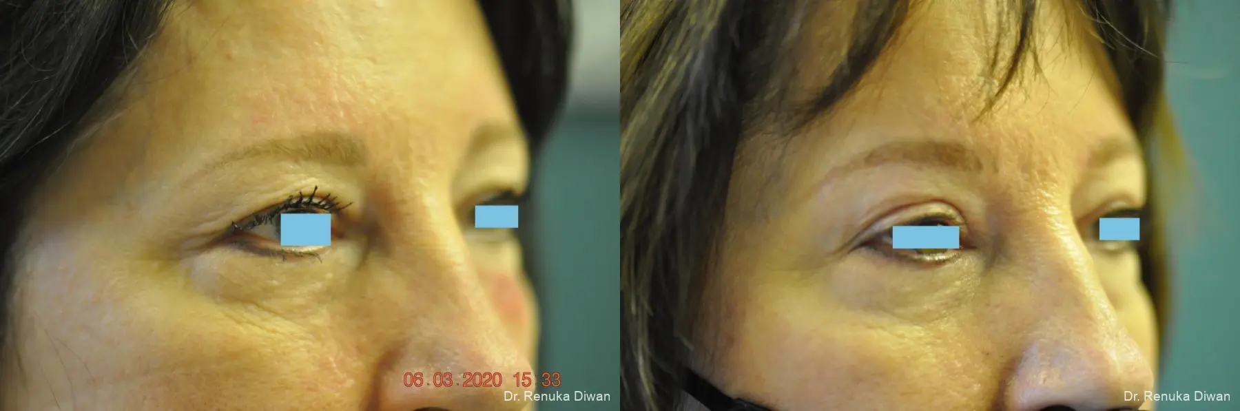 Blepharoplasty: Patient 9 - Before and After 2