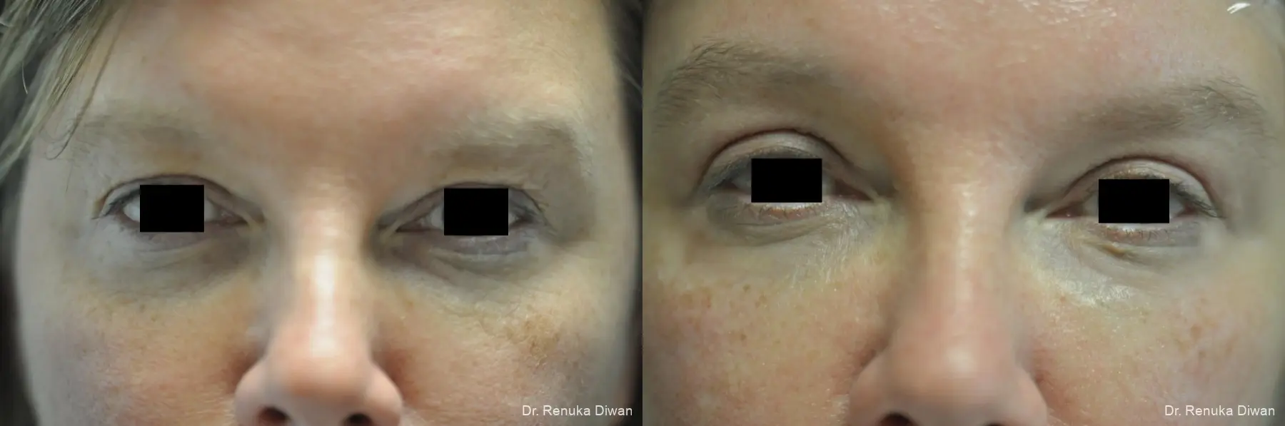 Blepharoplasty: Patient 2 - Before and After 5