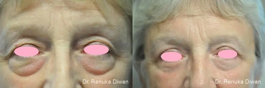 Blepharoplasty: Patient 15 - Before and After 1
