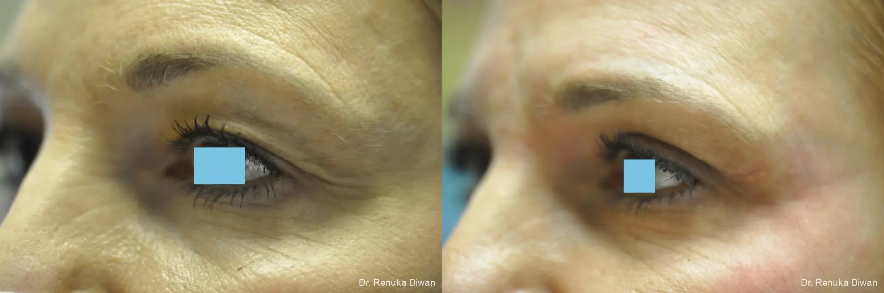 Blepharoplasty: Patient 7 - Before and After 1