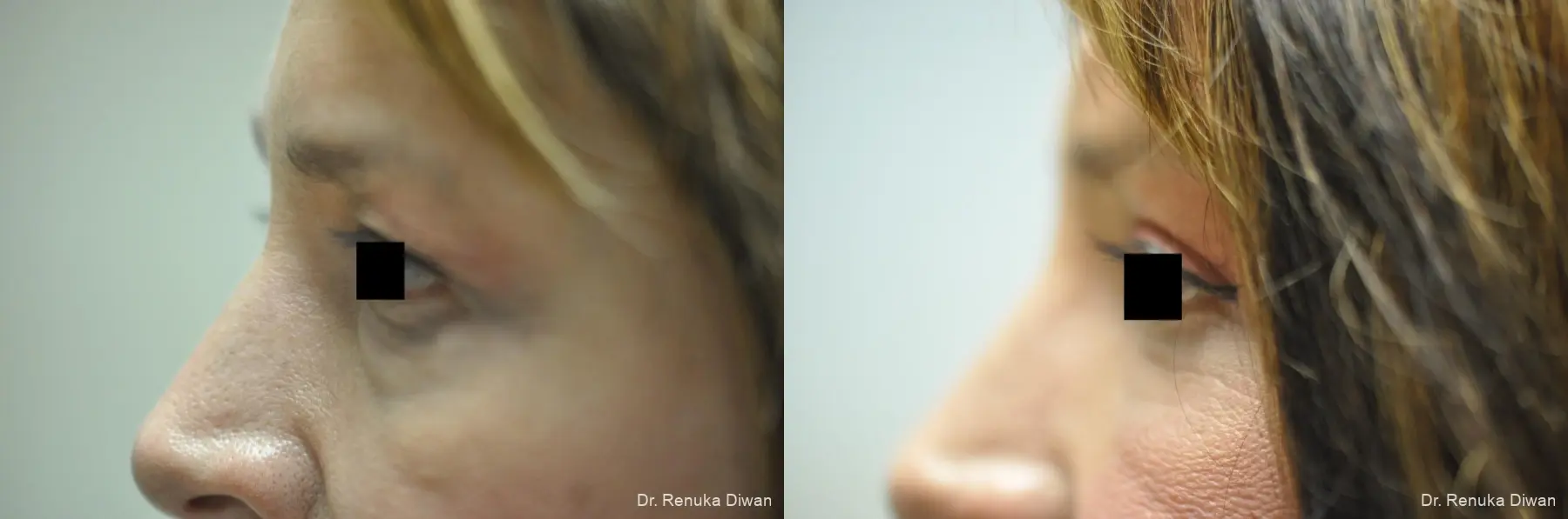 Blepharoplasty: Patient 4 - Before and After 1