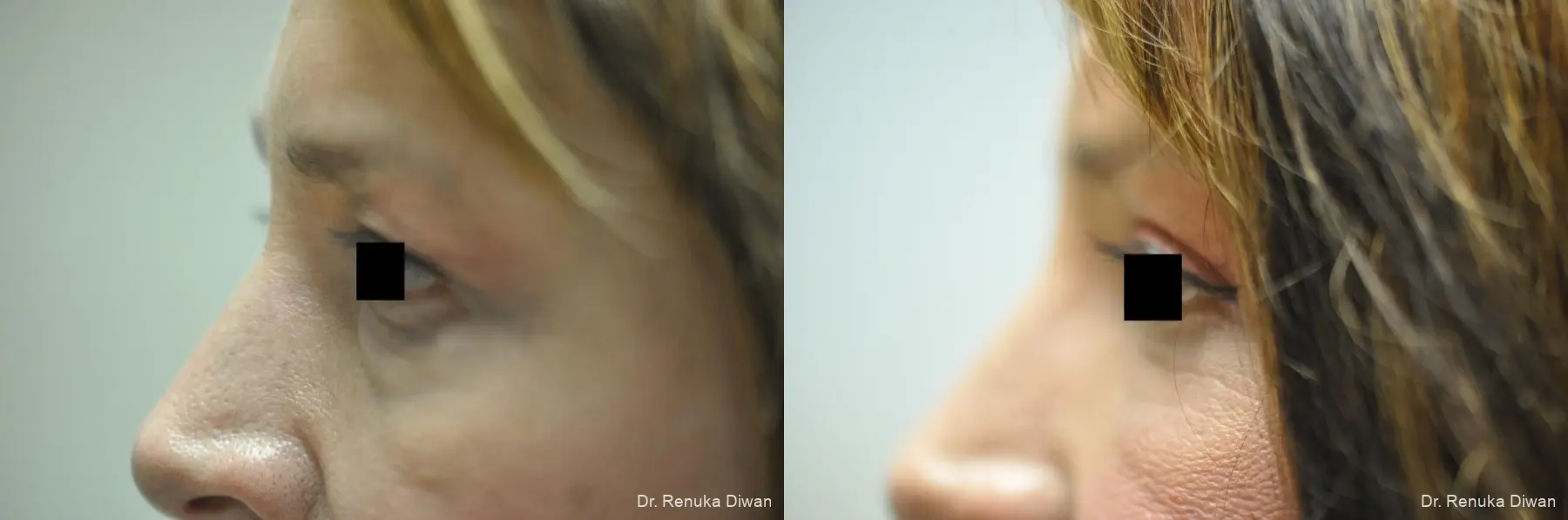 Blepharoplasty: Patient 4 - Before and After  