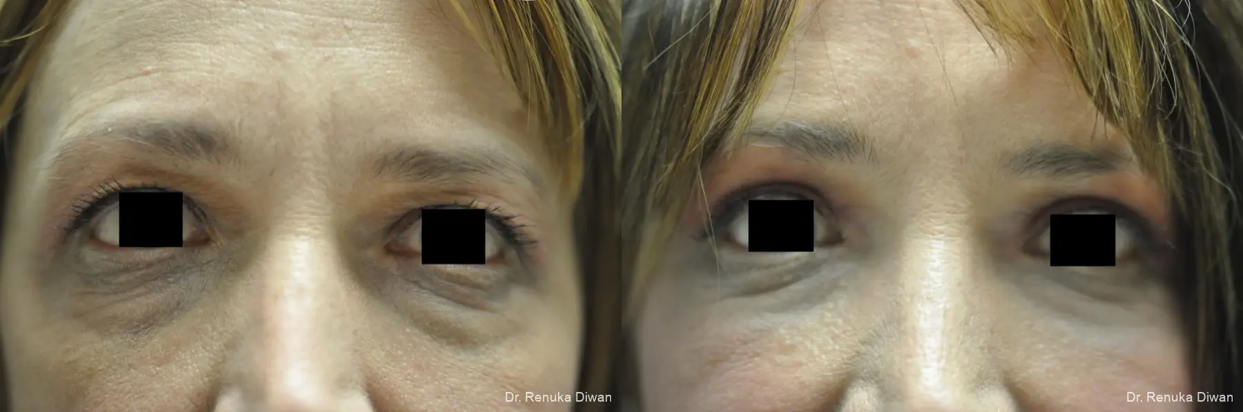 Blepharoplasty: Patient 4 - Before and After 2