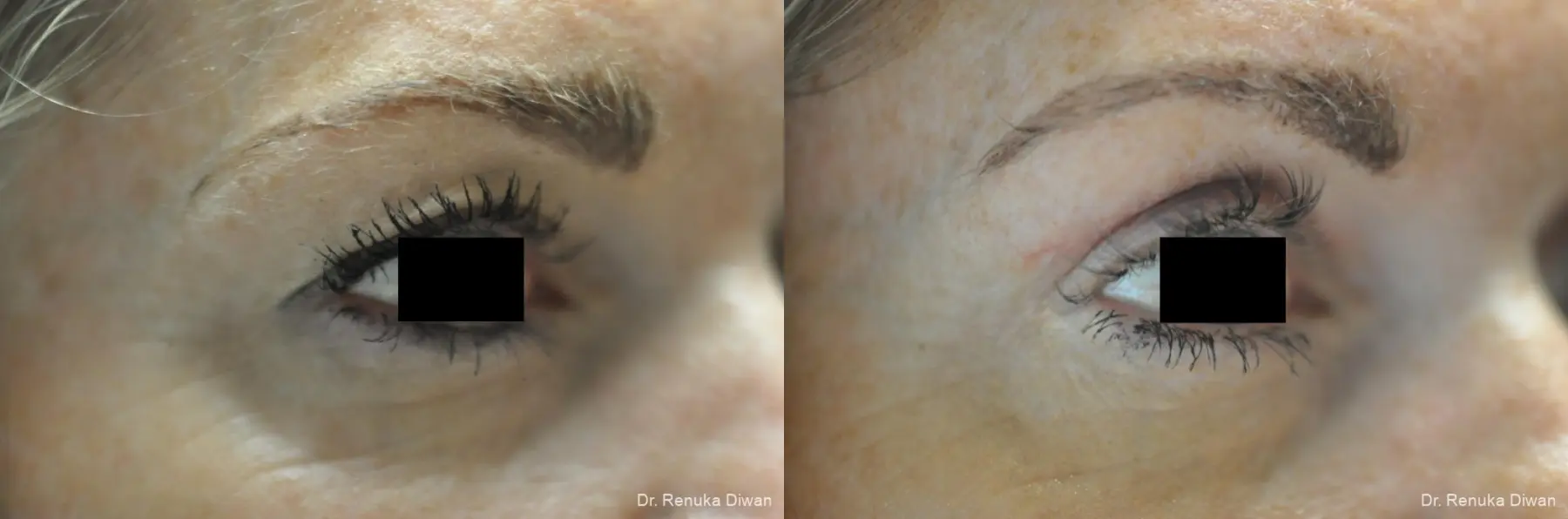 Blepharoplasty: Patient 1 - Before and After 4