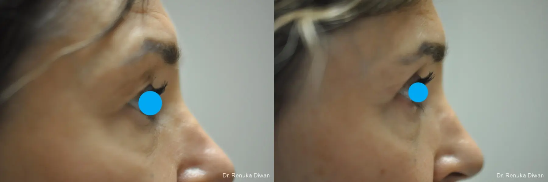 Blepharoplasty: Patient 21 - Before and After 4