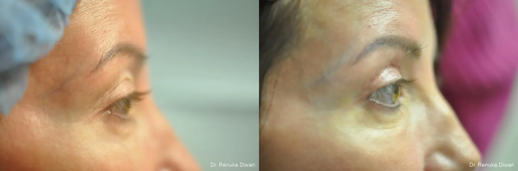 Blepharoplasty: Patient 23 - Before and After 1