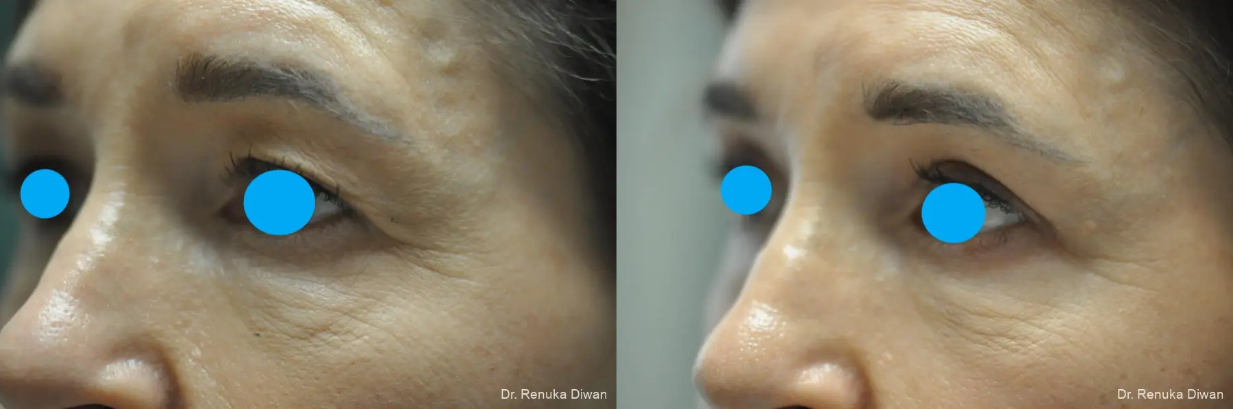 Blepharoplasty: Patient 21 - Before and After 3
