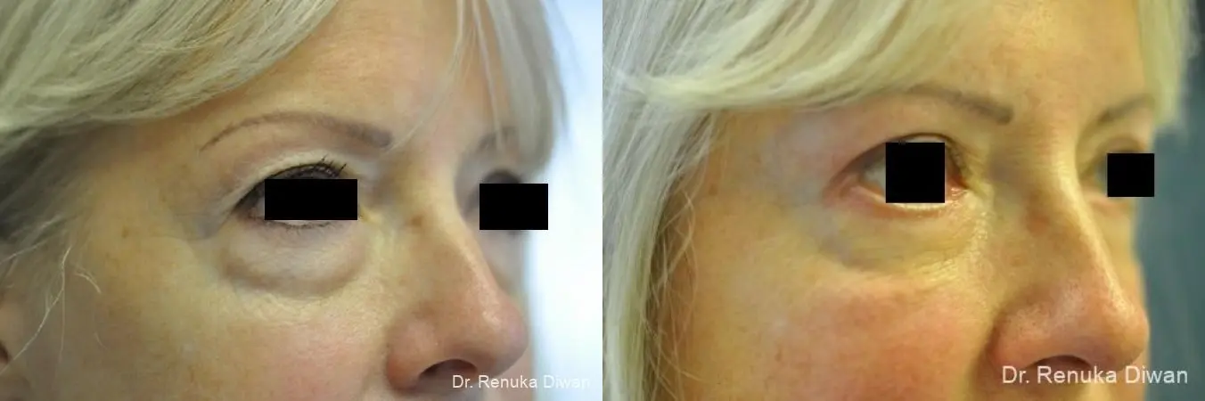 Blepharoplasty: Patient 13 - Before and After 1