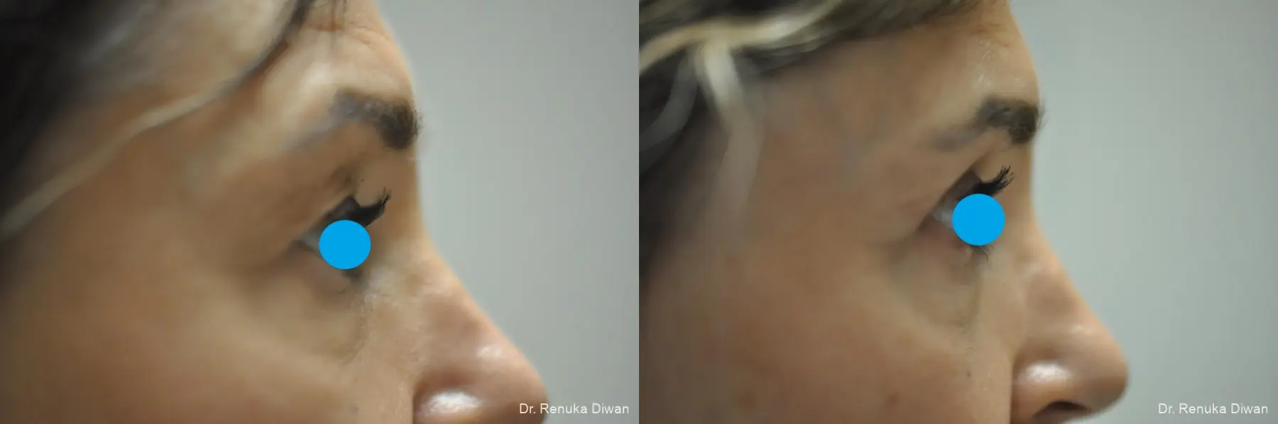 Blepharoplasty: Patient 22 - Before and After 5