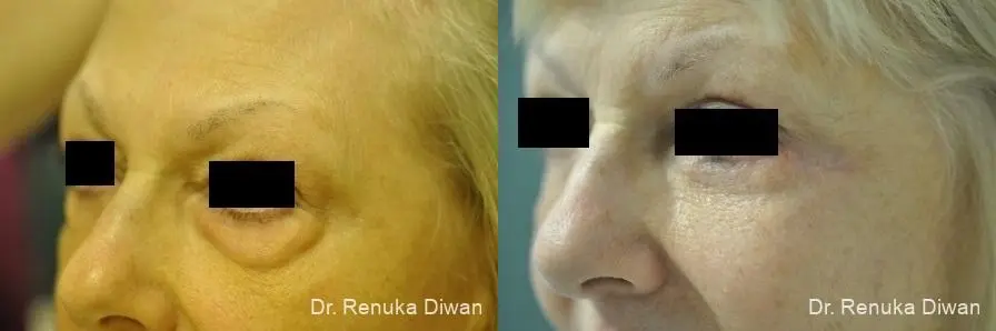 Blepharoplasty: Patient 18 - Before and After 1