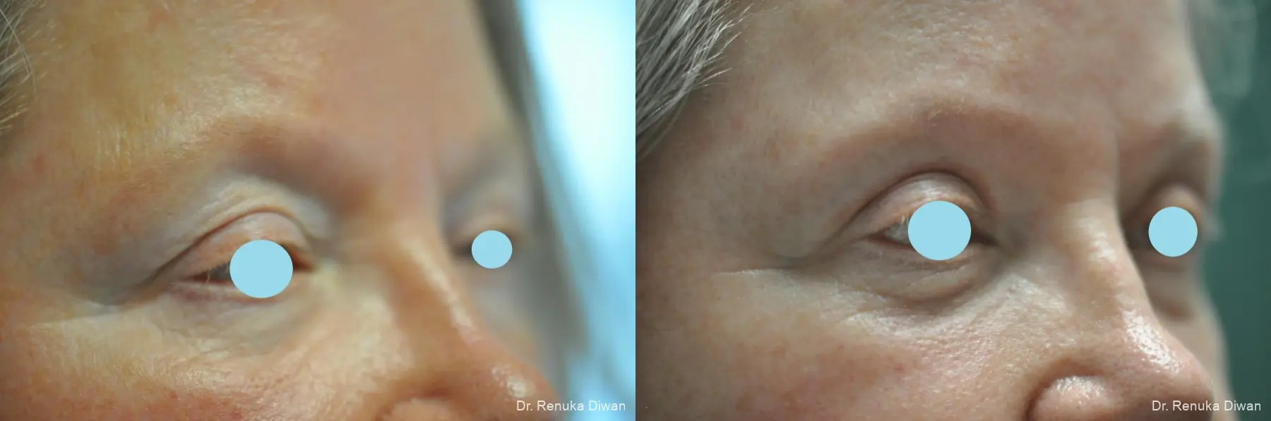 Blepharoplasty: Patient 19 - Before and After 2