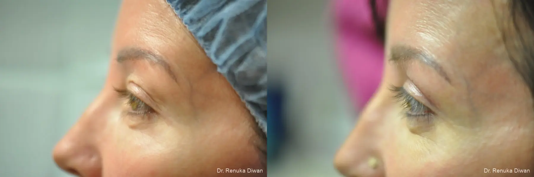 Blepharoplasty: Patient 23 - Before and After 5