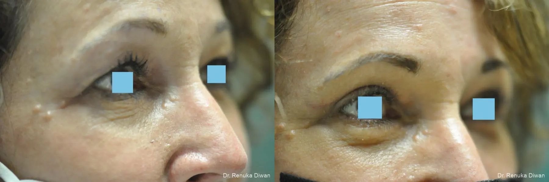 Blepharoplasty: Patient 5 - Before and After 1