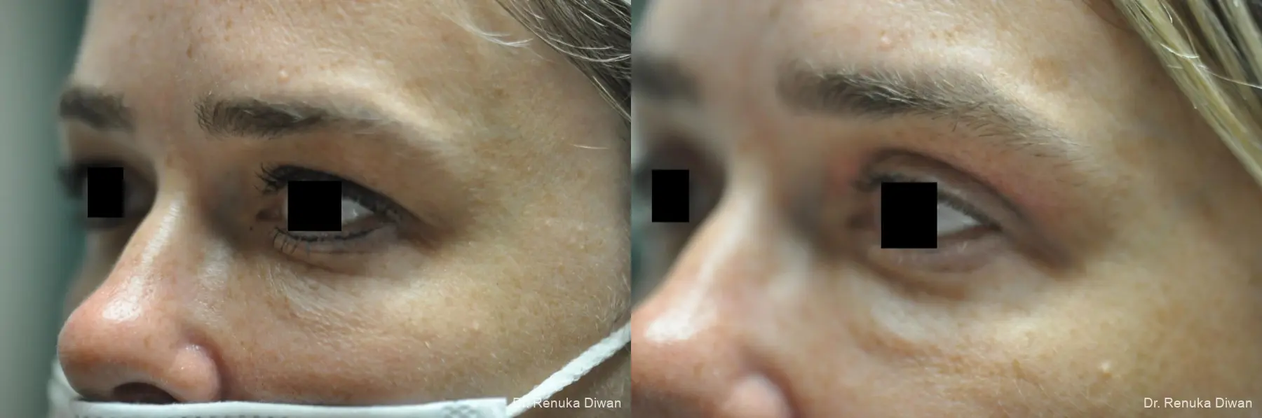 Blepharoplasty: Patient 3 - Before and After 3