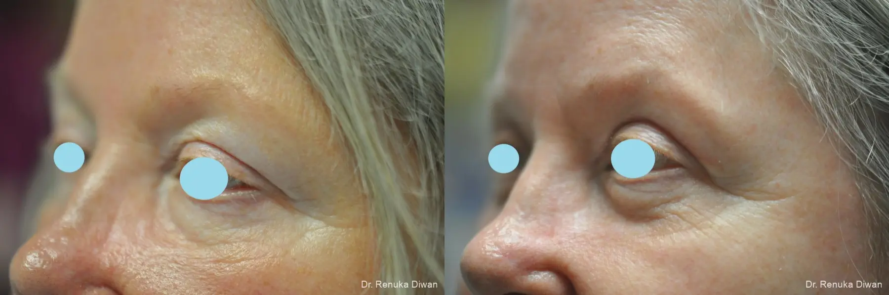 Blepharoplasty: Patient 19 - Before and After 4