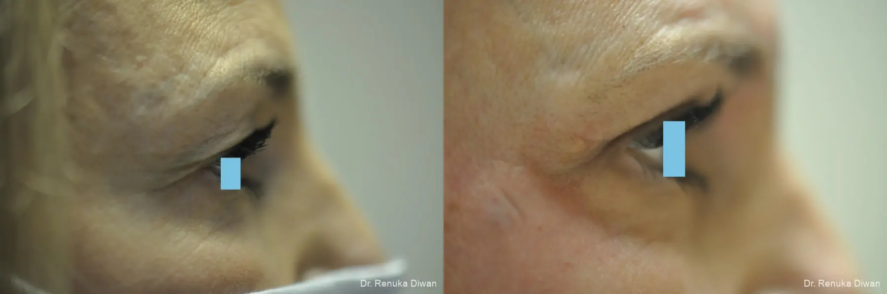 Blepharoplasty: Patient 7 - Before and After 5