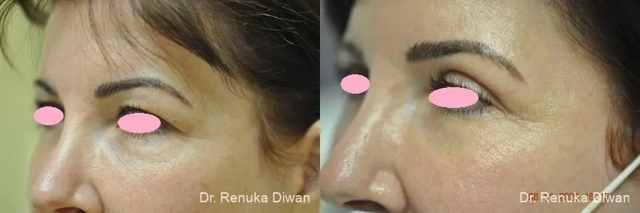 Blepharoplasty: Patient 8 - Before and After 3