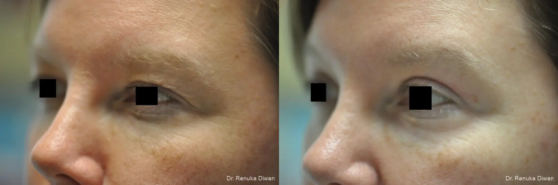 Blepharoplasty: Patient 2 - Before and After 3