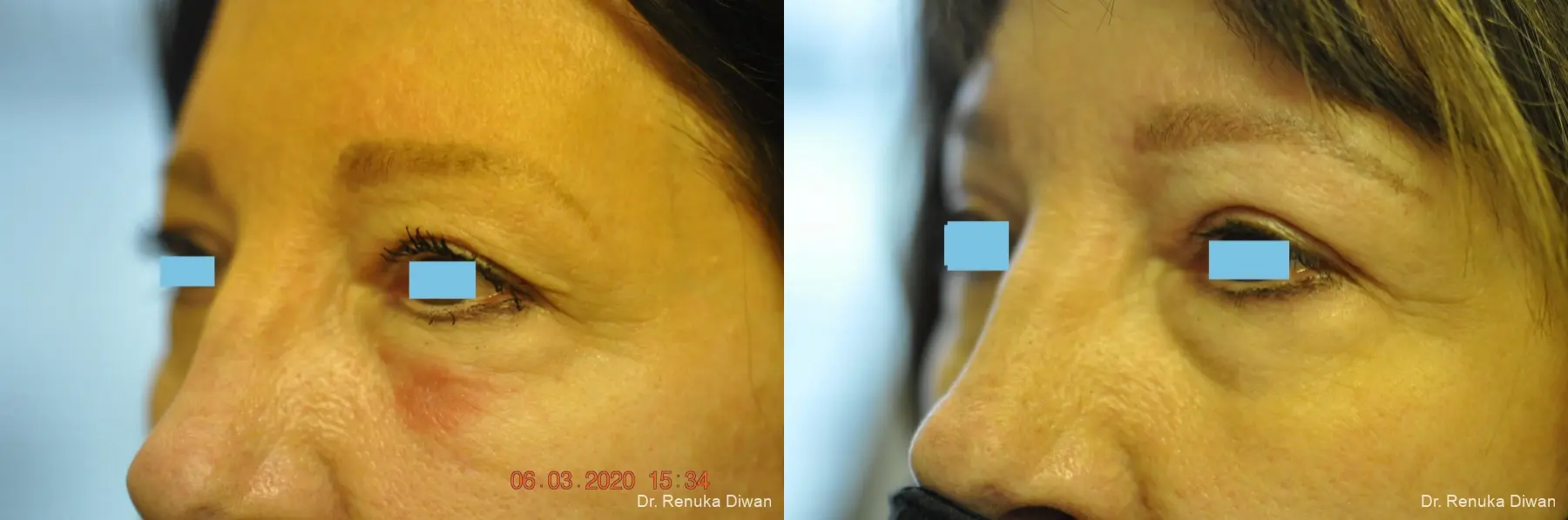 Blepharoplasty: Patient 9 - Before and After 4