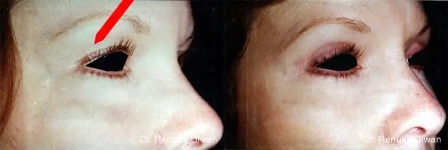 Blepharoplasty: Patient 16 - Before and After 1