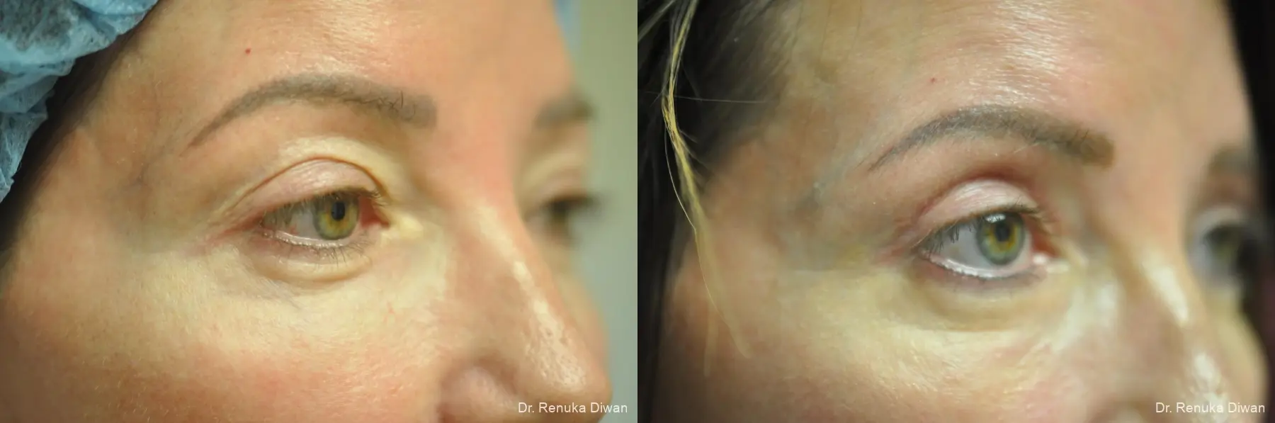 Blepharoplasty: Patient 23 - Before and After 2