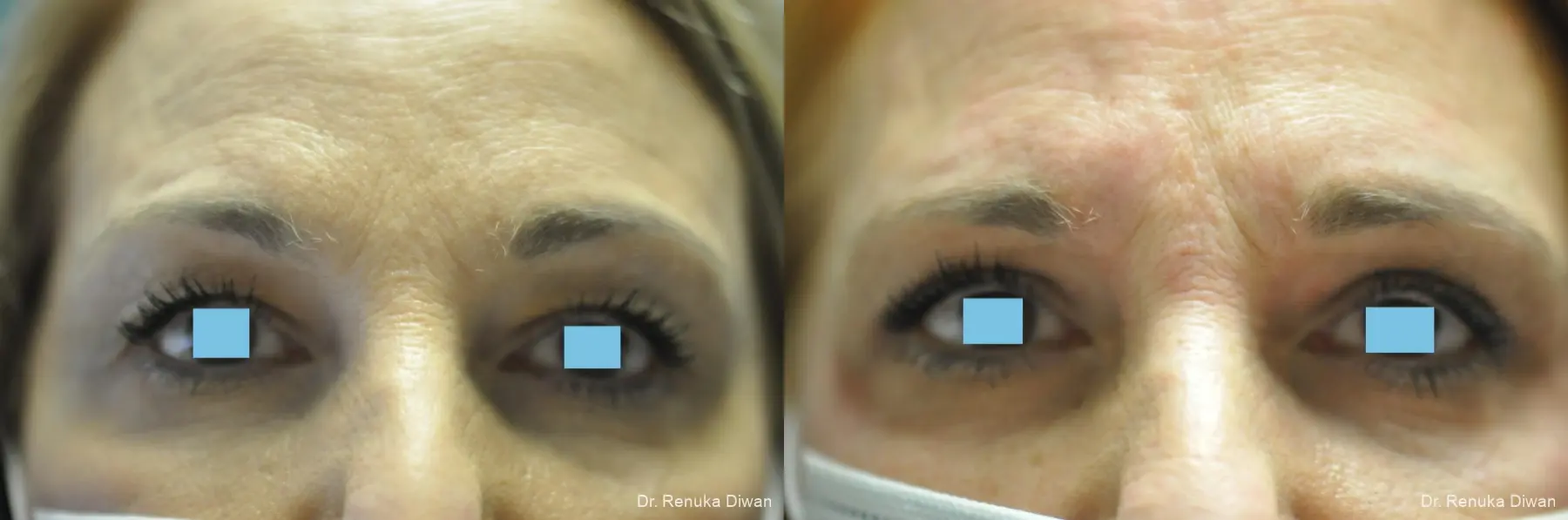 Blepharoplasty: Patient 7 - Before and After 2