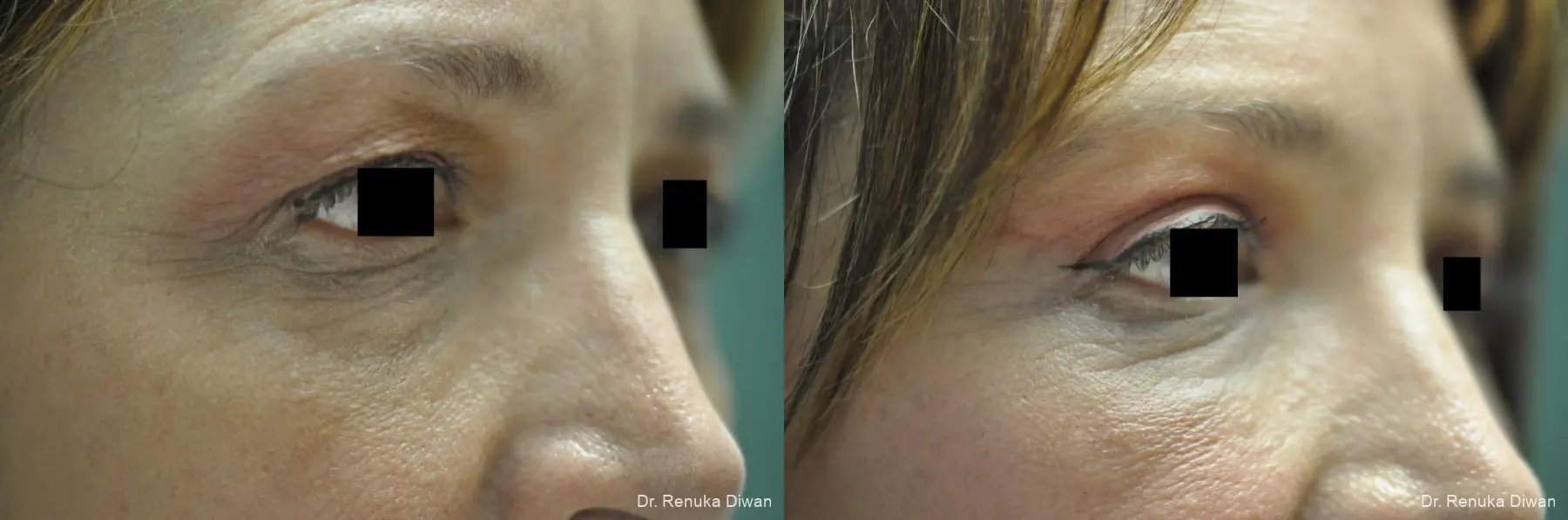 Blepharoplasty: Patient 4 - Before and After 3