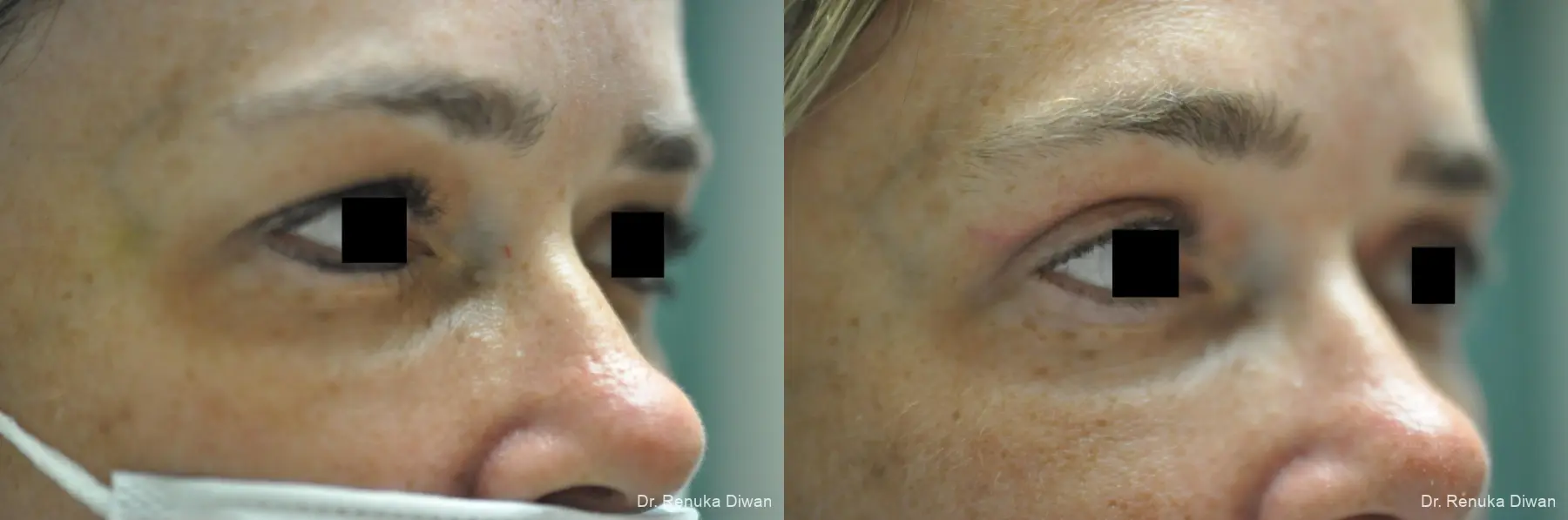 Blepharoplasty: Patient 3 - Before and After 5