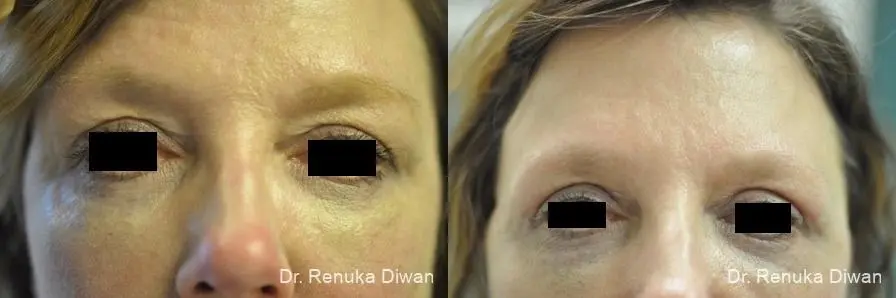 Blepharoplasty: Patient 12 - Before and After 1