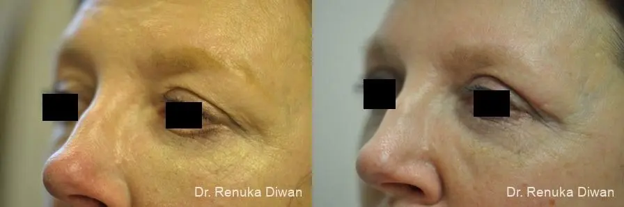 Blepharoplasty: Patient 12 - Before and After 2