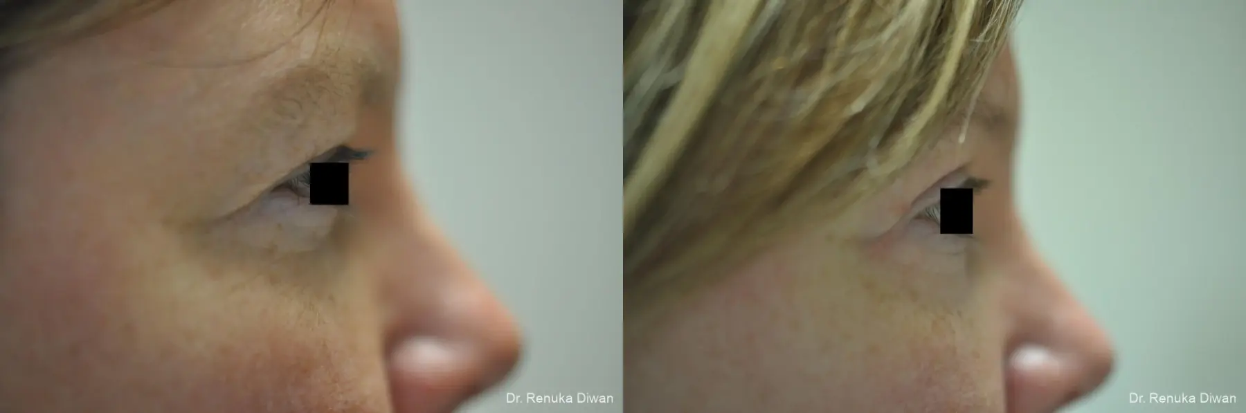 Blepharoplasty: Patient 2 - Before and After 2