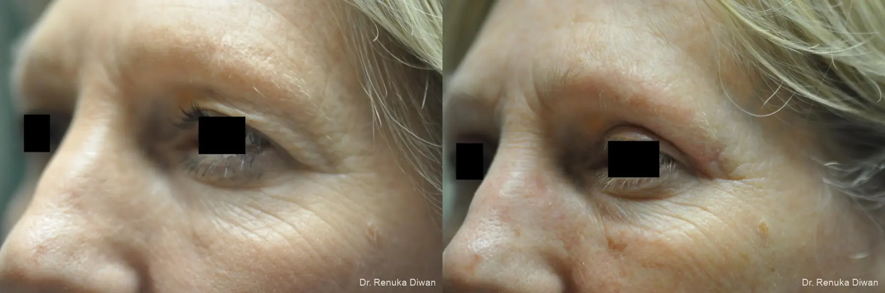 Blepharoplasty: Patient 19 - Before and After 2