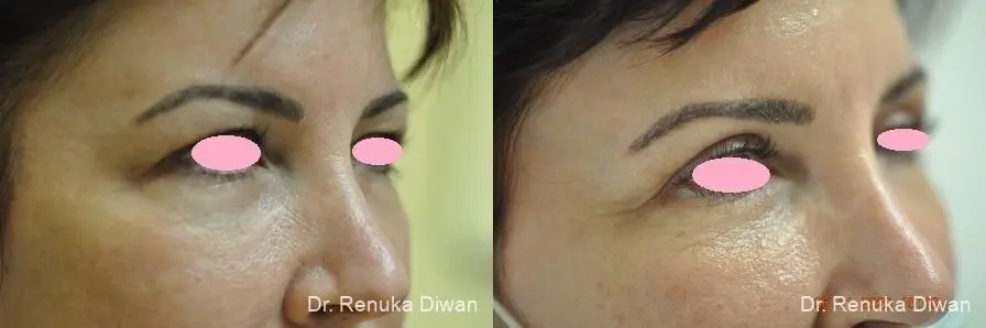 Blepharoplasty: Patient 8 - Before and After 2