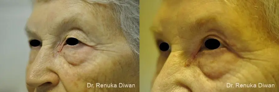 Blepharoplasty: Patient 14 - Before and After 1