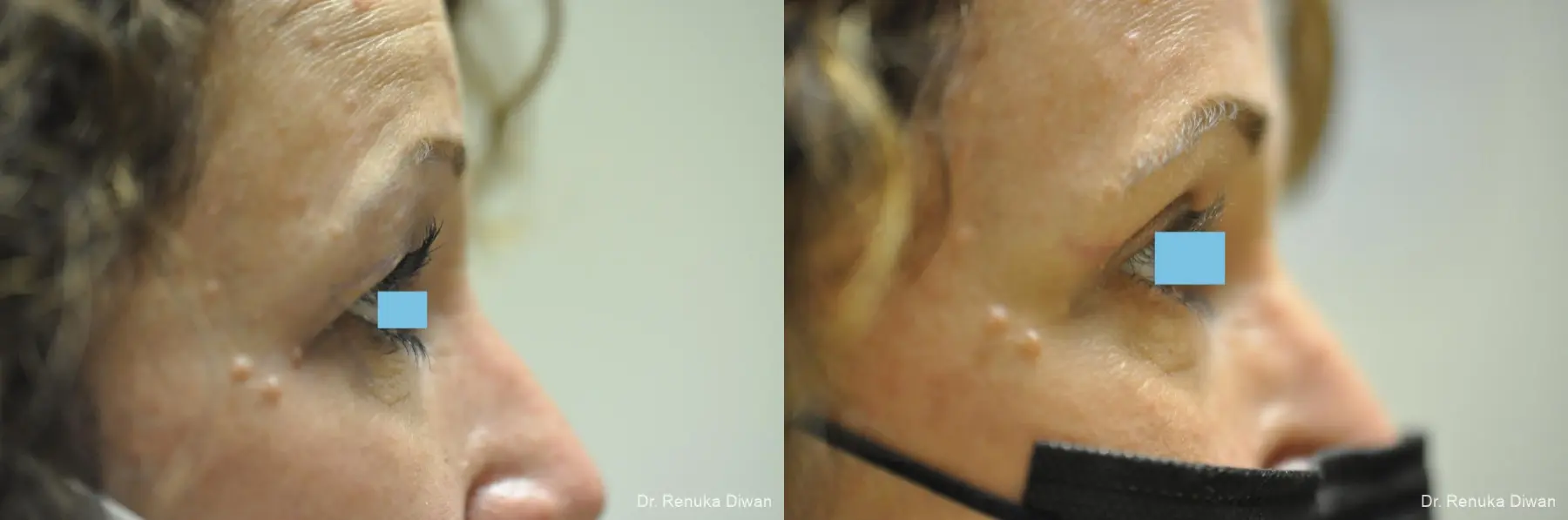 Blepharoplasty: Patient 14 - Before and After 3