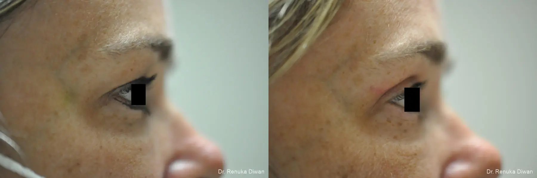 Blepharoplasty: Patient 3 - Before and After 4