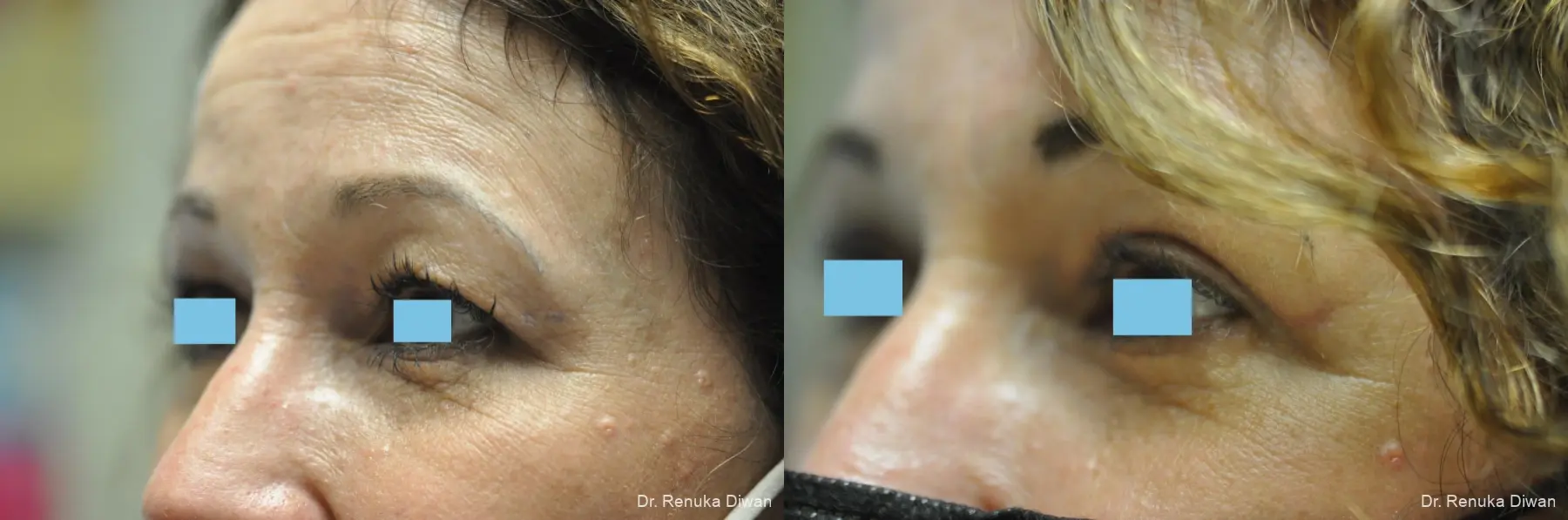 Blepharoplasty: Patient 14 - Before and After 4