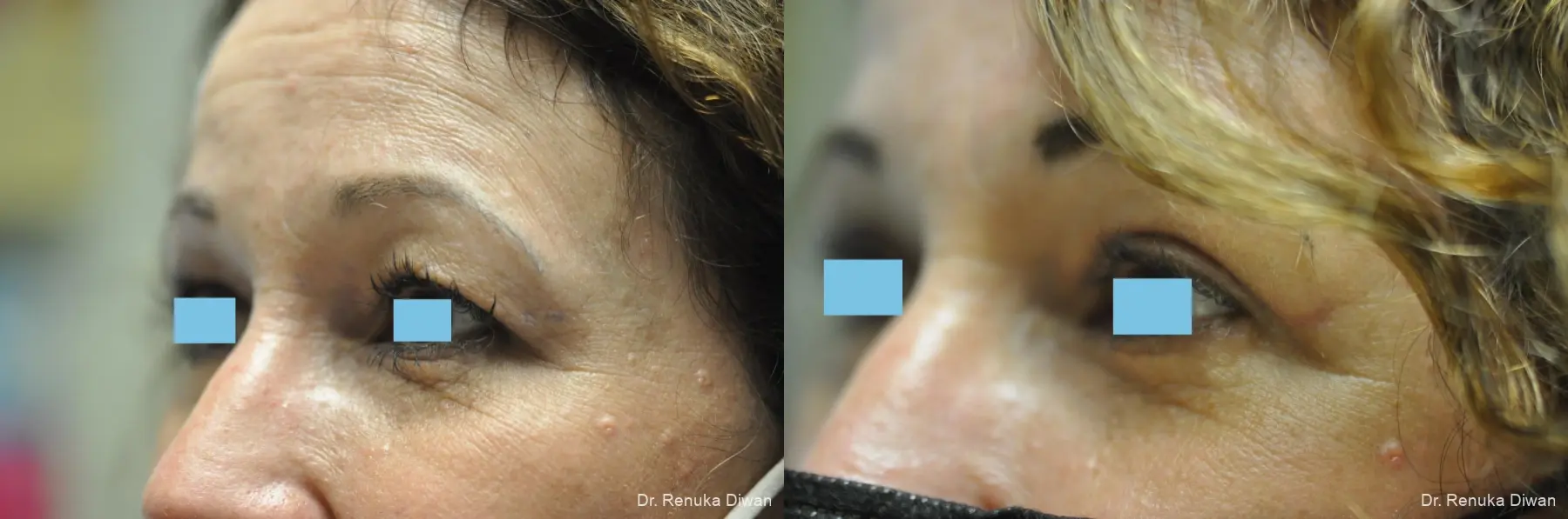 Blepharoplasty: Patient 5 - Before and After 4