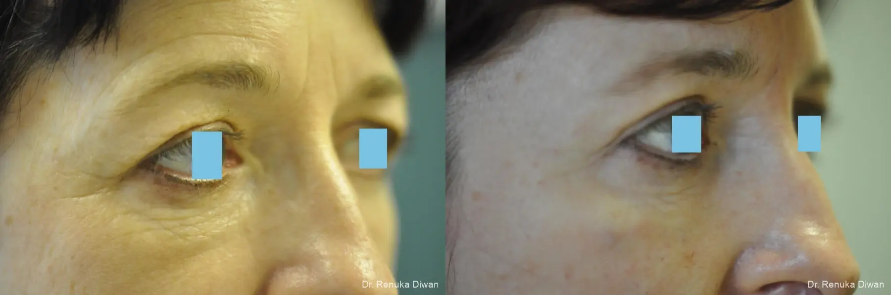 Blepharoplasty: Patient 11 - Before and After 1