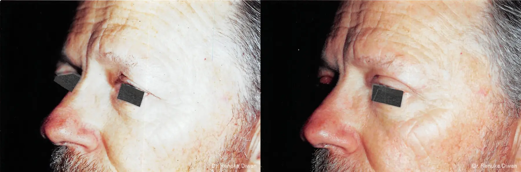 Blepharoplasty-for-men: Patient 1 - Before and After  