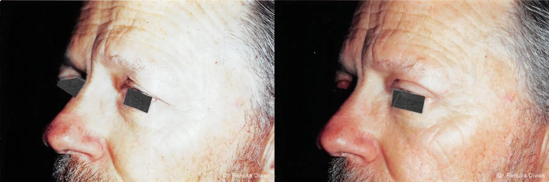 Blepharoplasty For Men: Patient 1 - Before and After 1