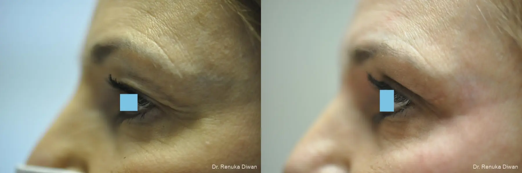 Blepharoplasty: Patient 7 - Before and After 3