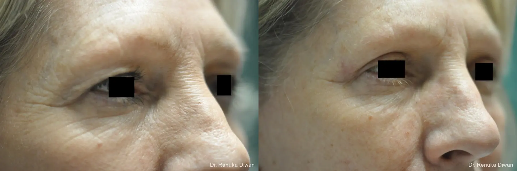 Blepharoplasty: Patient 19 - Before and After 1