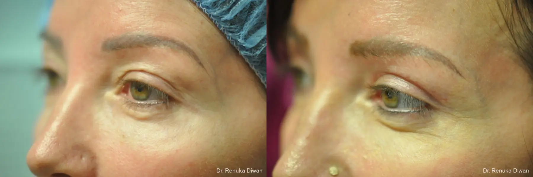 Blepharoplasty: Patient 23 - Before and After 4